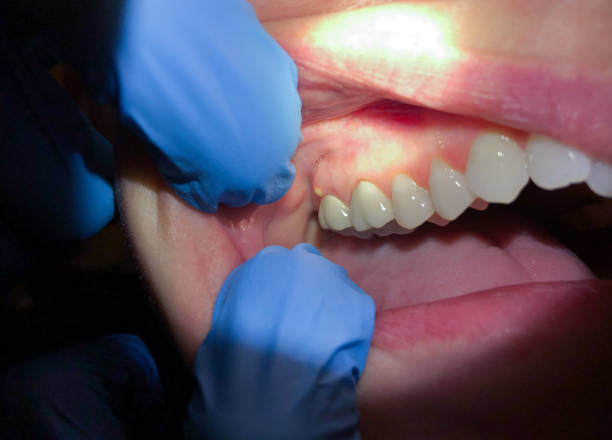 Best Emergency Care for Gum Disease in Kennedale, TX